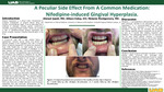 A Peculiar Side Effect From A Common Medication: Nifedipine-induced Gingival Hyperplasia by Ahmed Qaedi, Allison Estep, and Melanie Montgomery